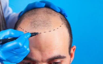 What is a Hair Transplant?